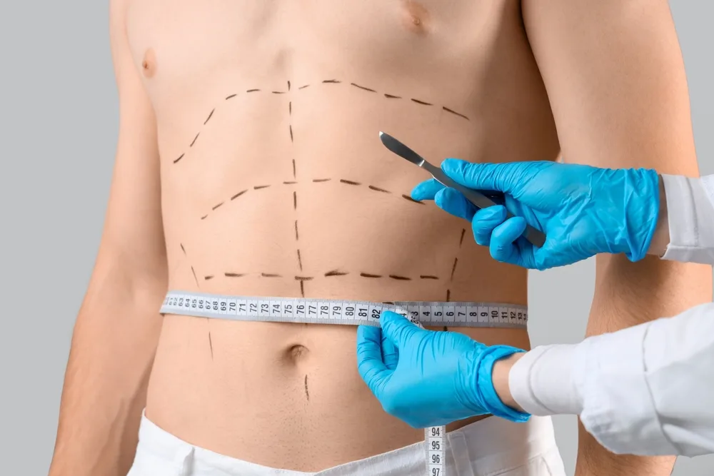 Treatment areas mapped and measured before a fat transfer