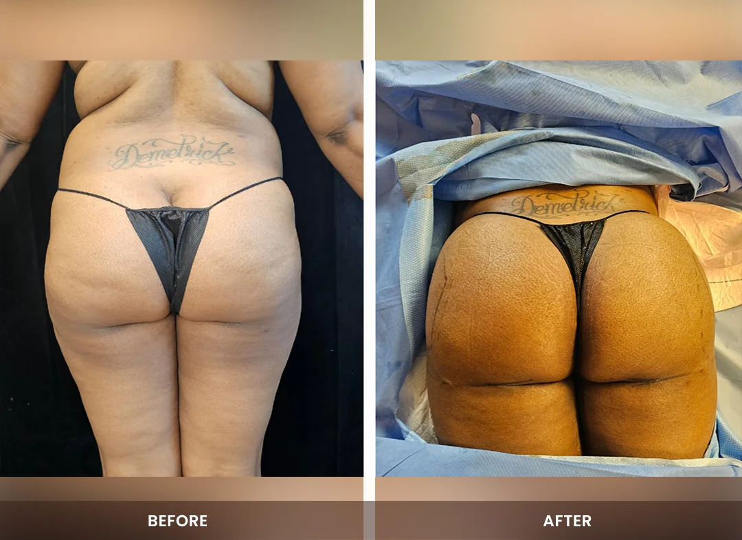 Fat Transfer before and after result — Buttocks