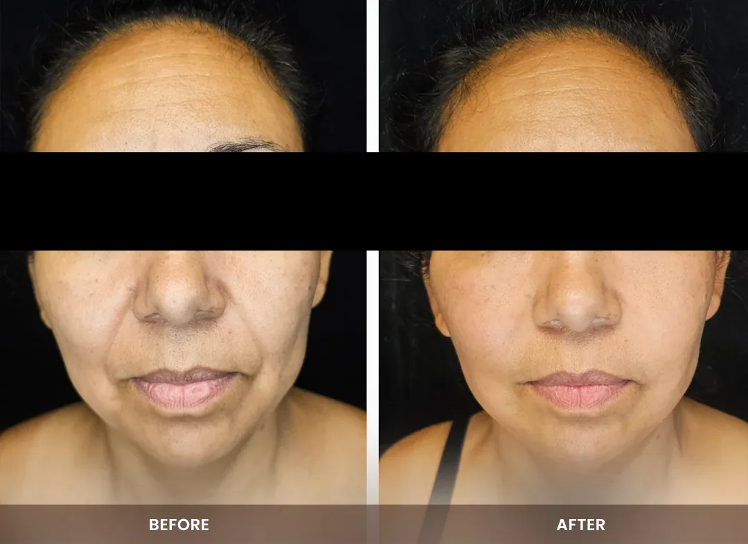 Fat Transfer before and after result — Face