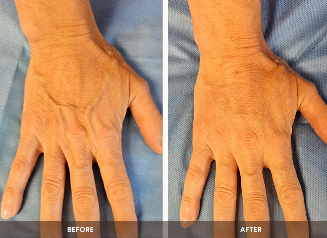 Fat Transfer before and after result — Hands
