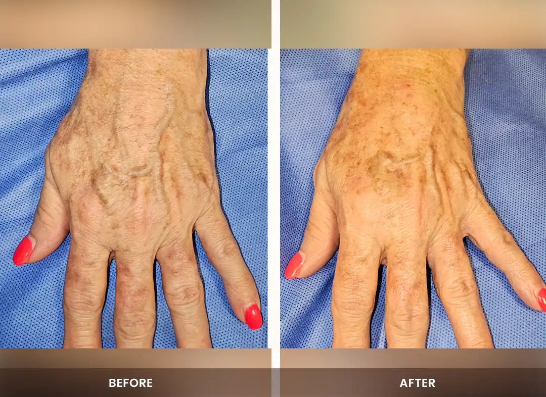 Fat Transfer before and after result — Hands