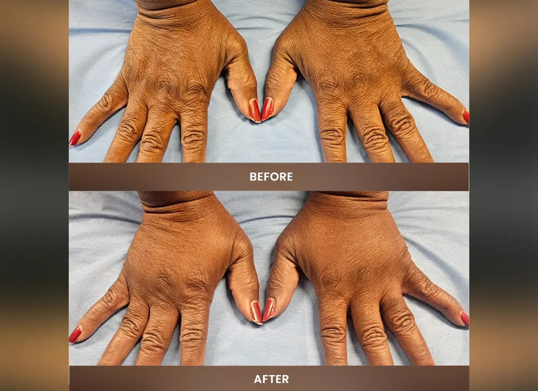 Fat Transfer before and after result — Hands