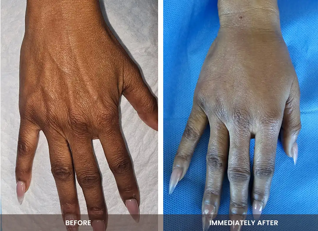 Fat Transfer before and after result — Hands