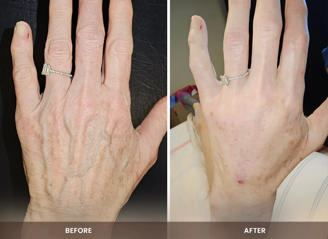 Fat Transfer before and after result — Hands