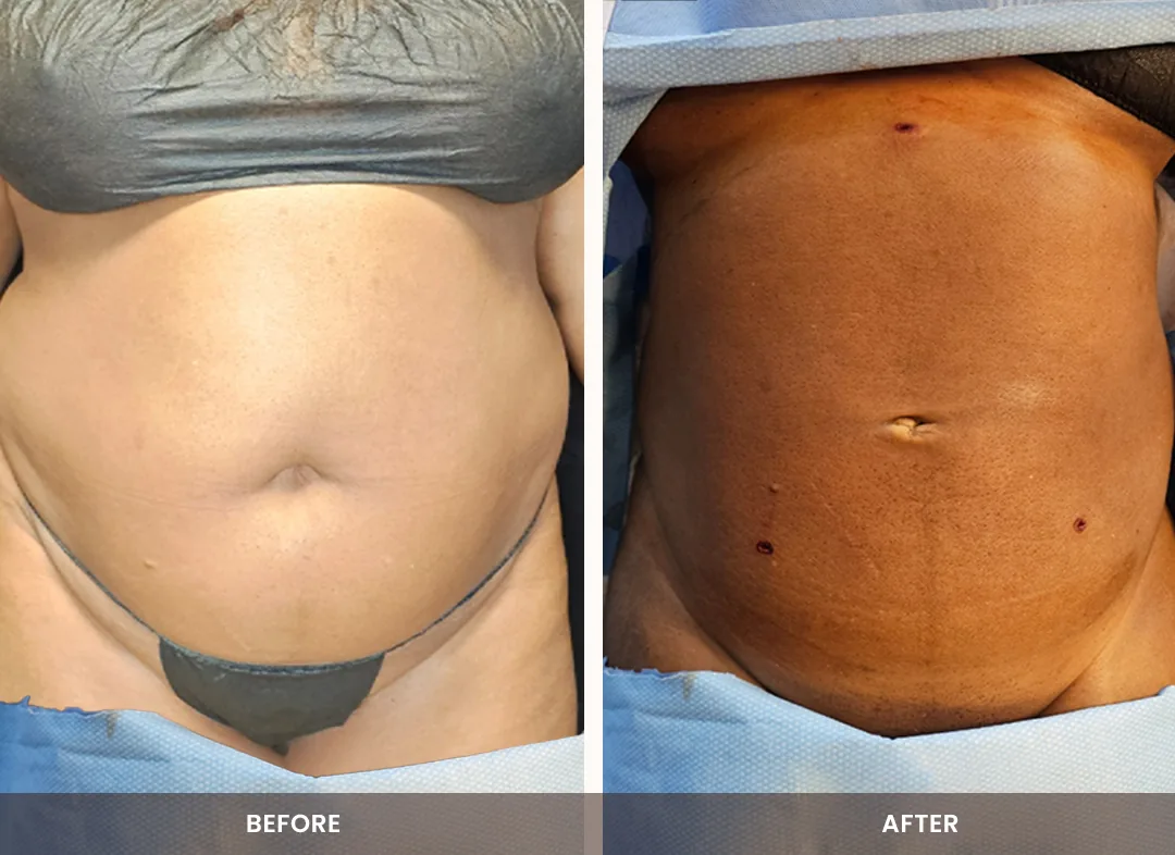 Laser Liposuction before and after result — Abdomen