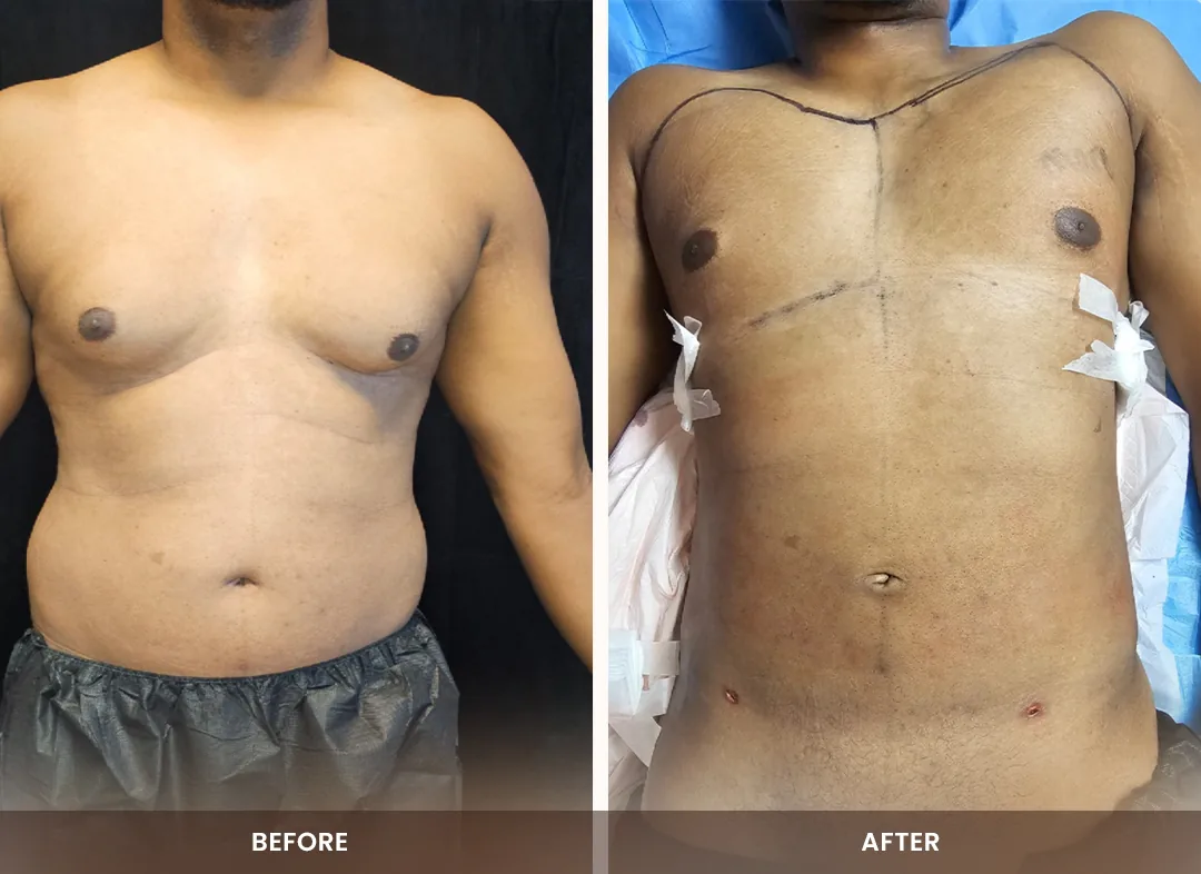 Laser Liposuction before and after result — Chest & abdomen