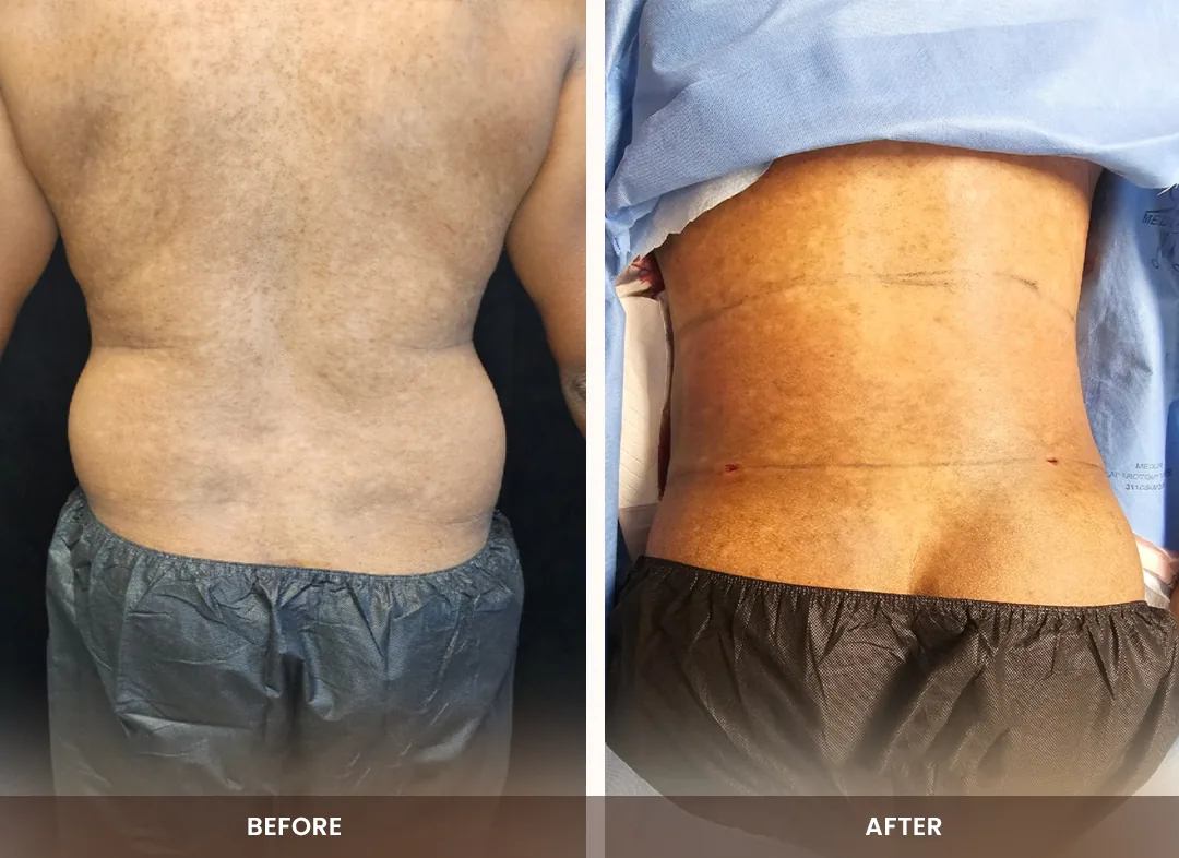 Laser Liposuction before and after result — Back & flanks