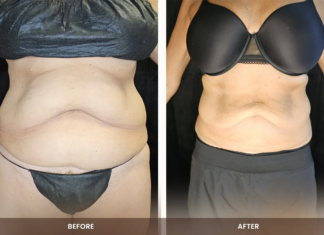 Laser Liposuction before and after result — Abdomen