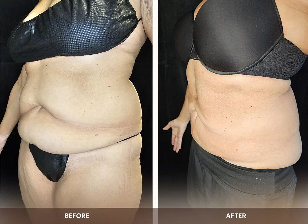 Laser Liposuction before and after result — Abdomen & flanks