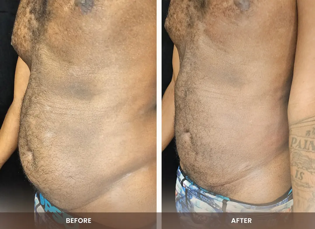 Laser Liposuction before and after result — Abdomen & flanks