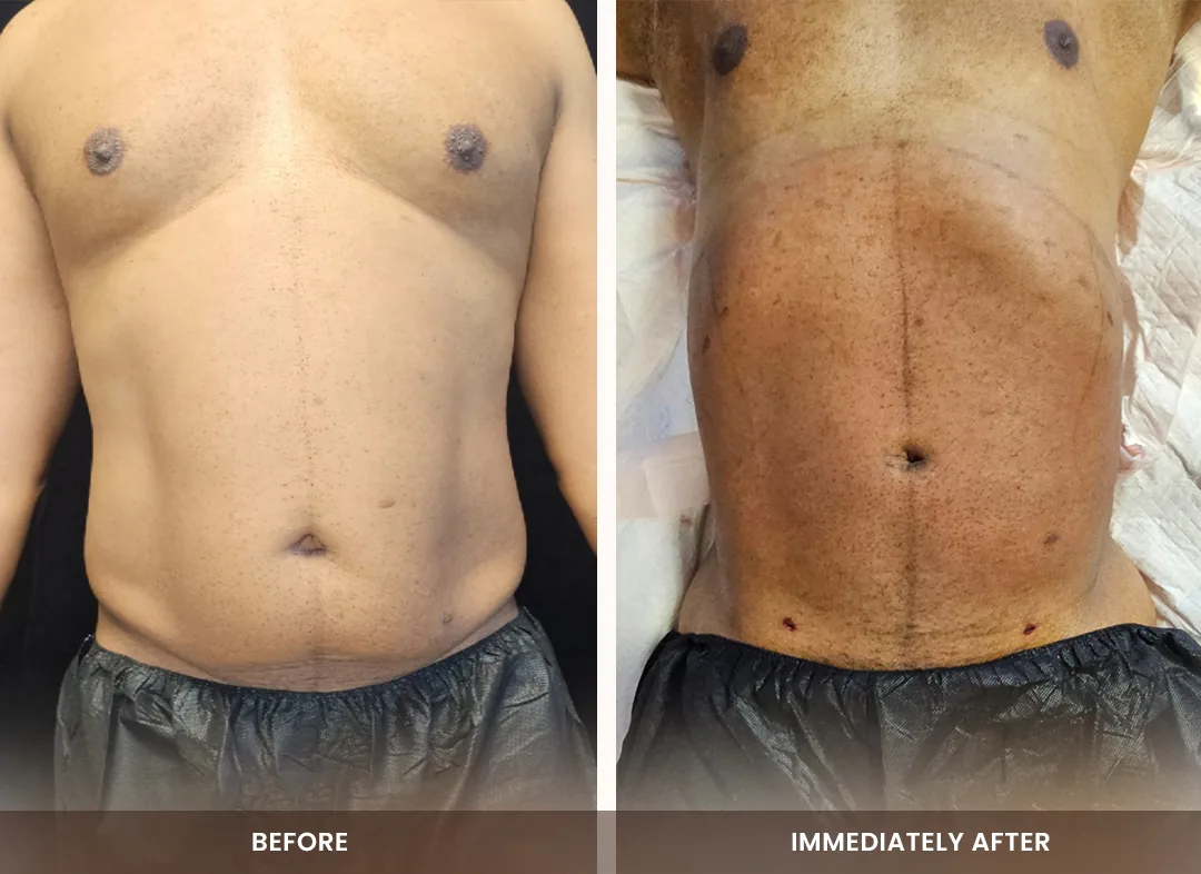 Laser Liposuction before and after result — Chest & abdomen