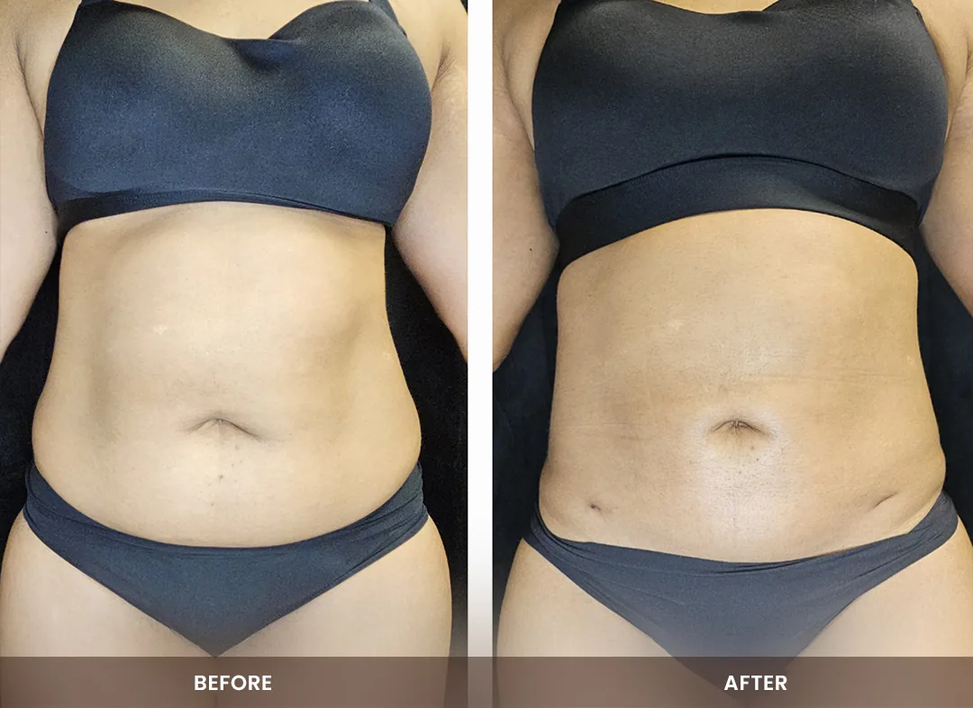 Laser Liposuction before and after result — Abdomen & waist