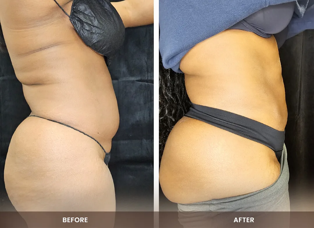 Laser Liposuction before and after result — Abdomen & flanks