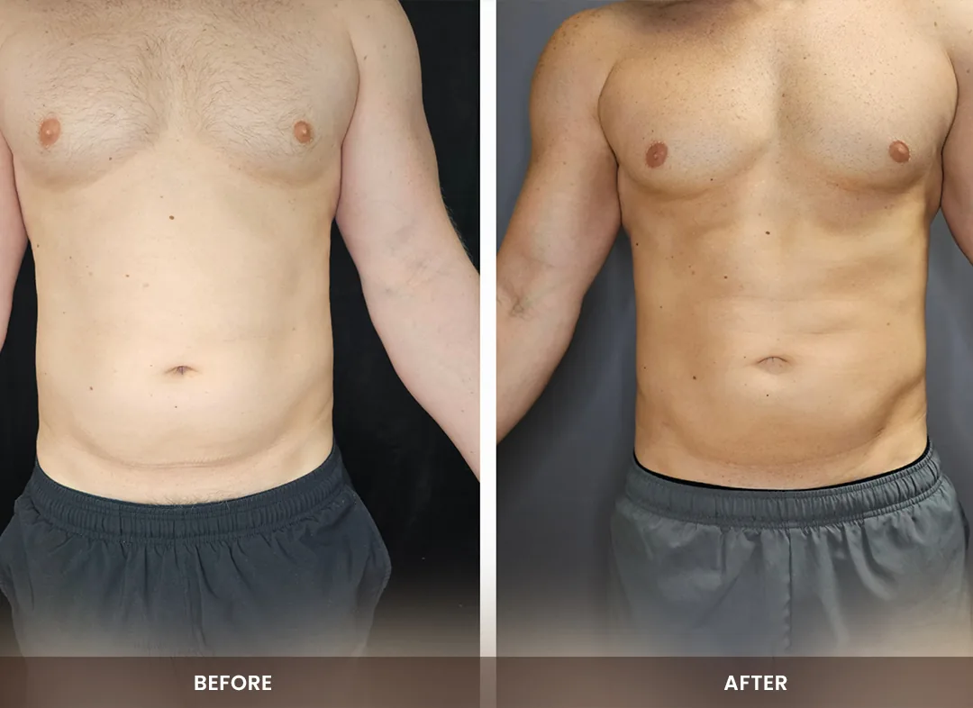 Laser Liposuction before and after result — Chest & abdomen