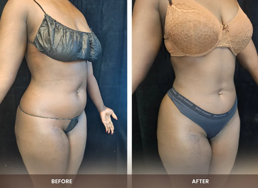 Laser Liposuction before and after result — Abdomen, hips & thighs