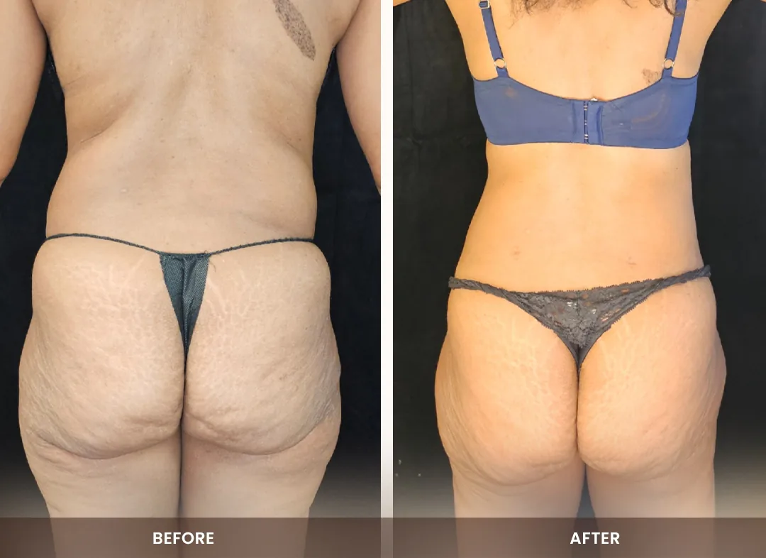 Laser Liposuction before and after result — Back, flanks & buttocks