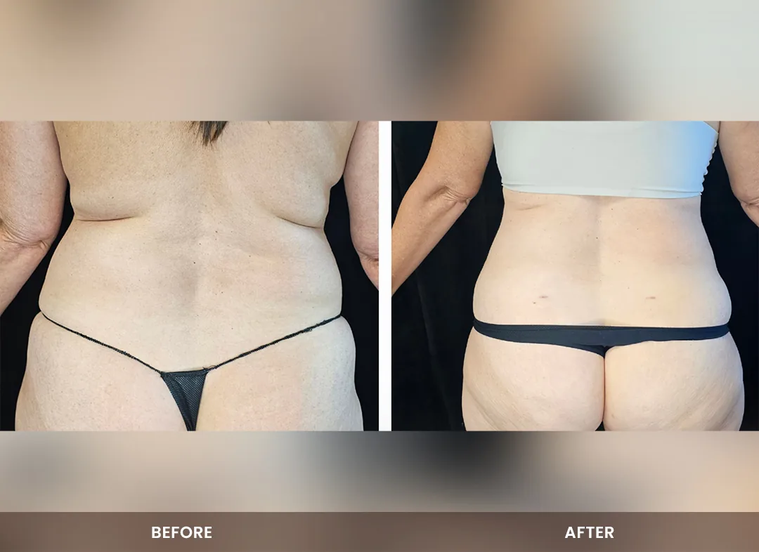 Laser Liposuction before and after result — Back & flanks