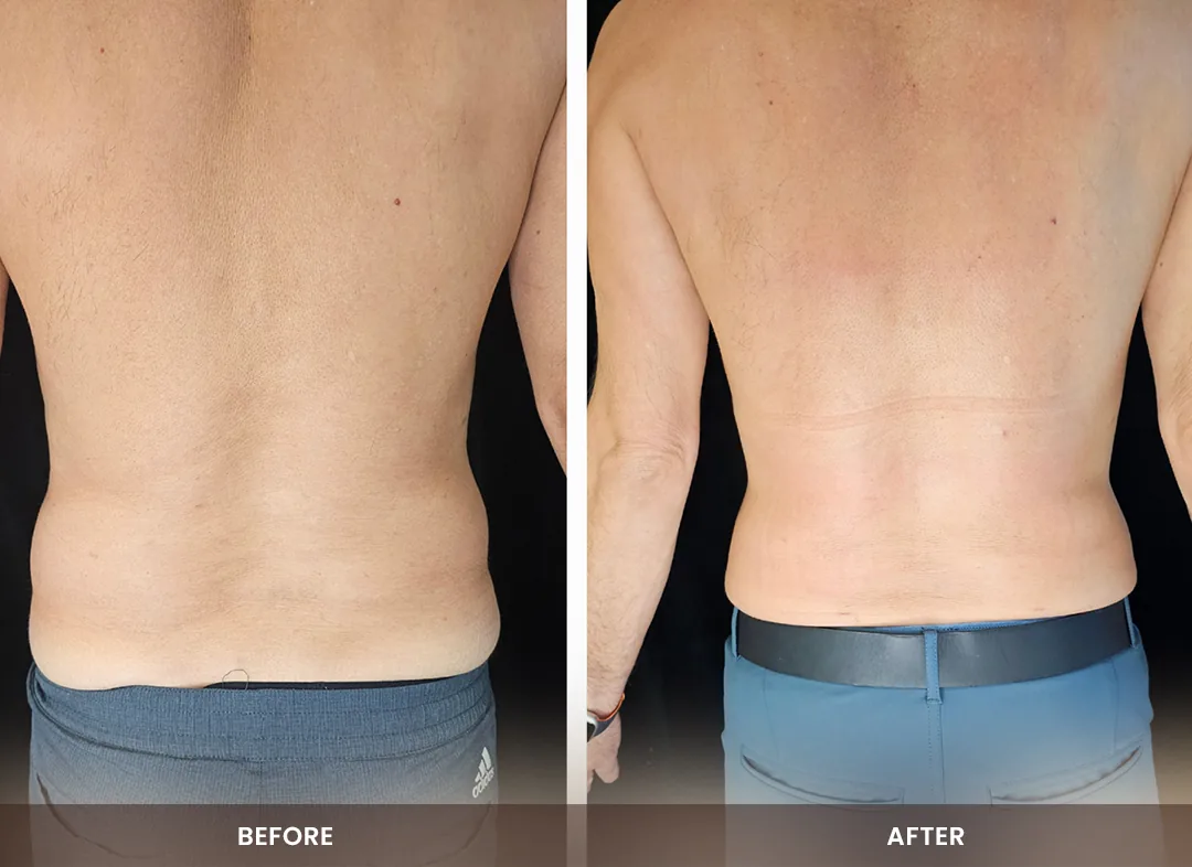 Laser Liposuction before and after result — Back & flanks