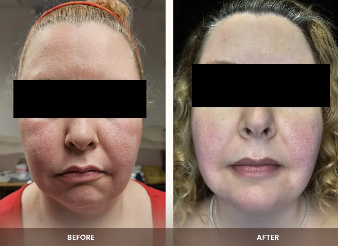 Laser Liposuction before and after result — Chin & jawline
