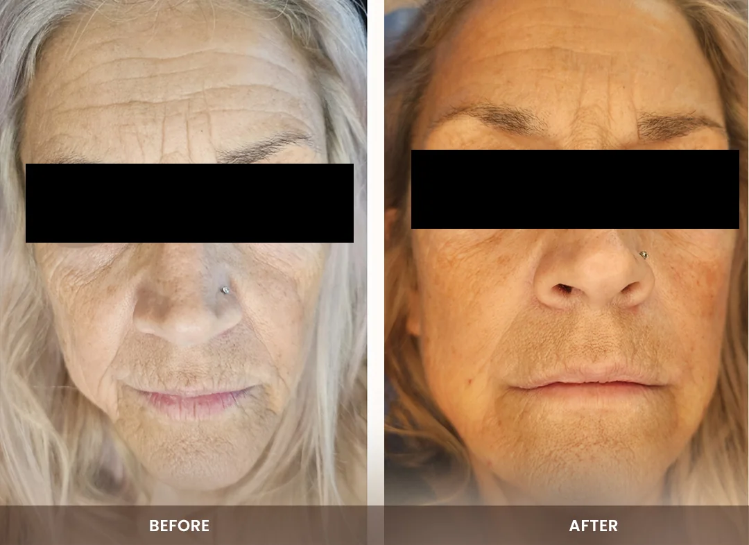 Laser Liposuction before and after result — Face & jawline