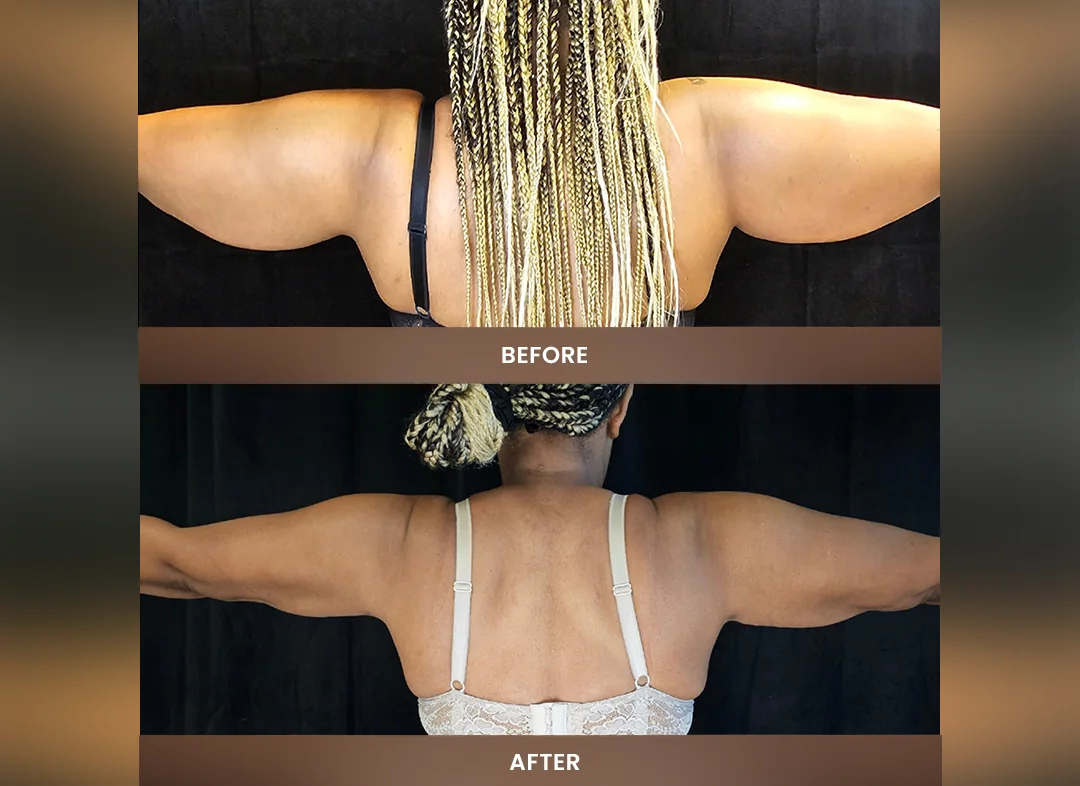 Laser Liposuction before and after result — Upper arms