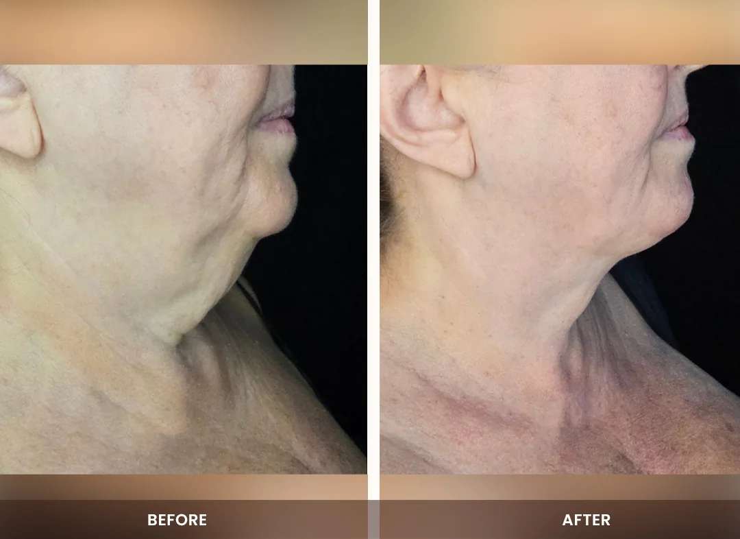 Laser Liposuction before and after result — Neck