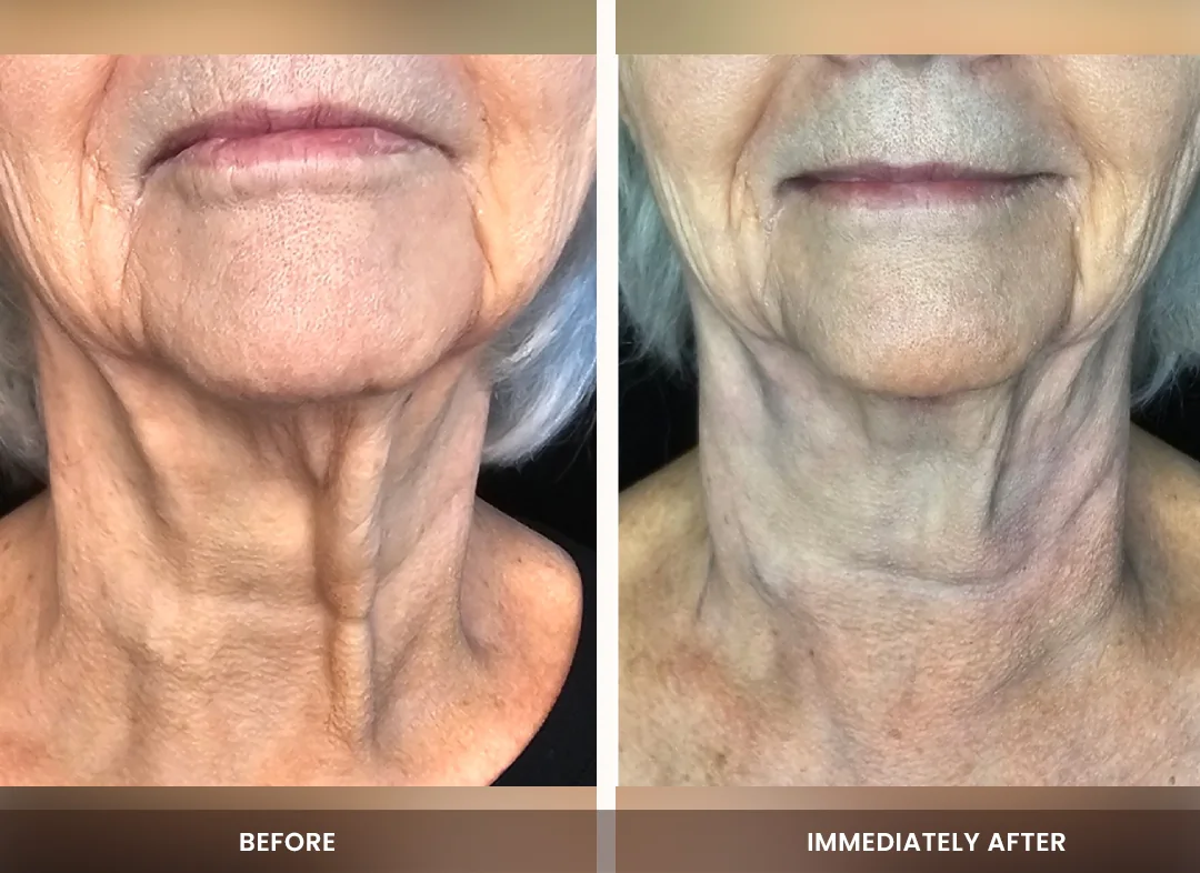 Laser Liposuction before and after result — Neck & jawline