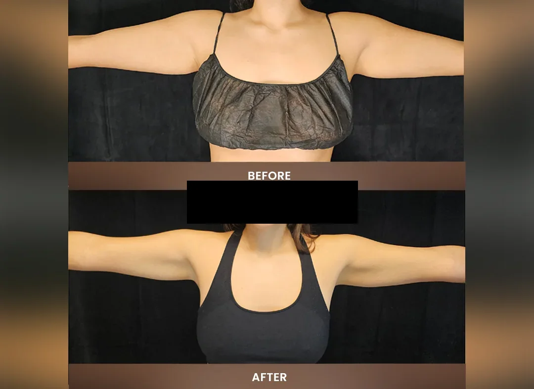 Laser Liposuction before and after result — Upper arms