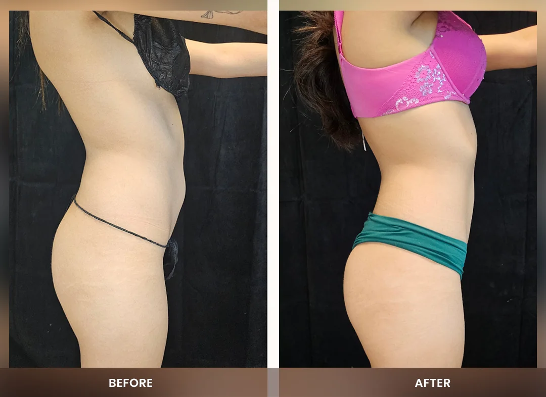 Laser Liposuction before and after result — Abdomen & flanks
