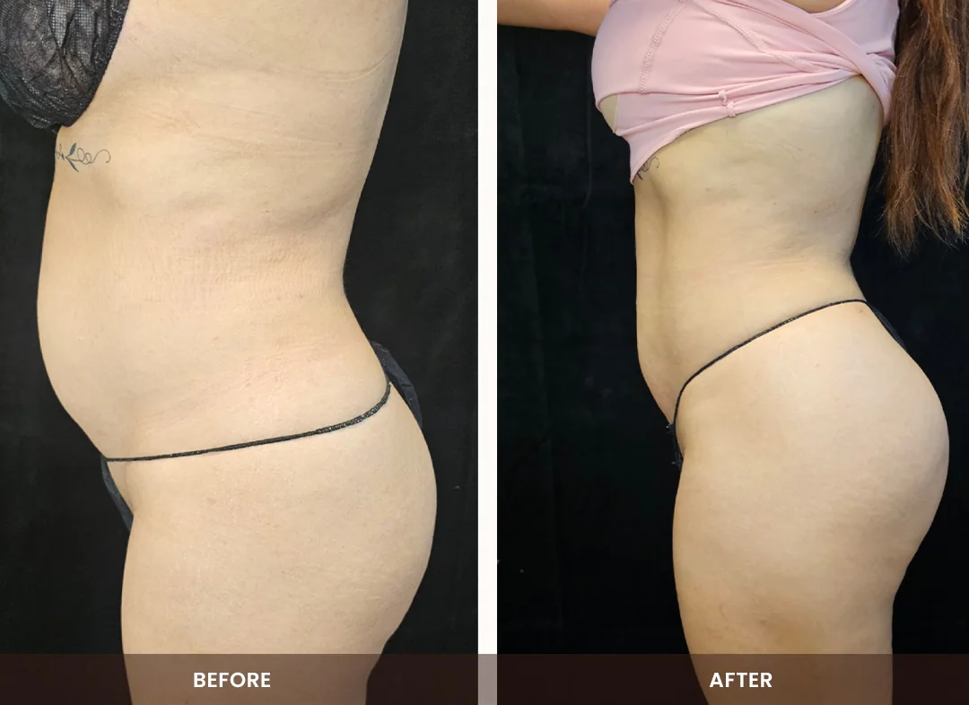 Laser Liposuction before and after result — Abdomen & flanks