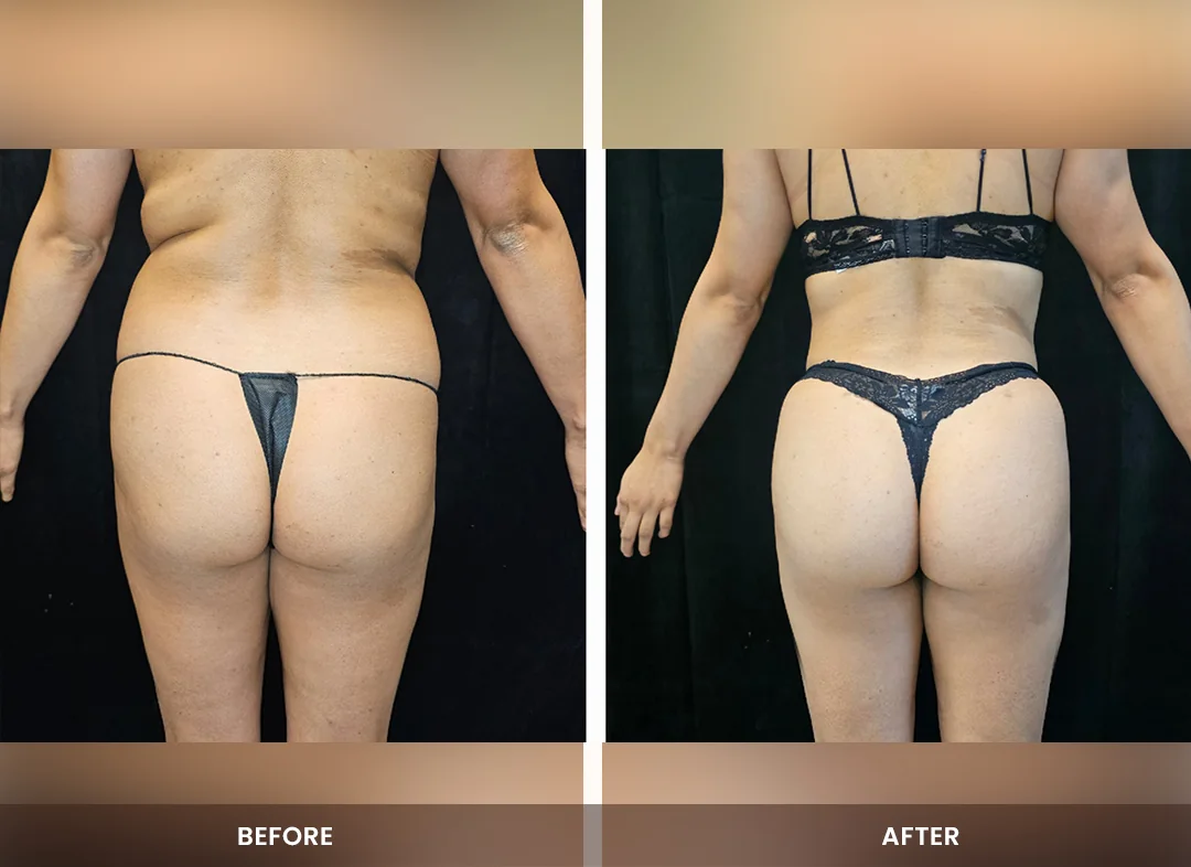 Laser Liposuction before and after result — Hips & buttocks