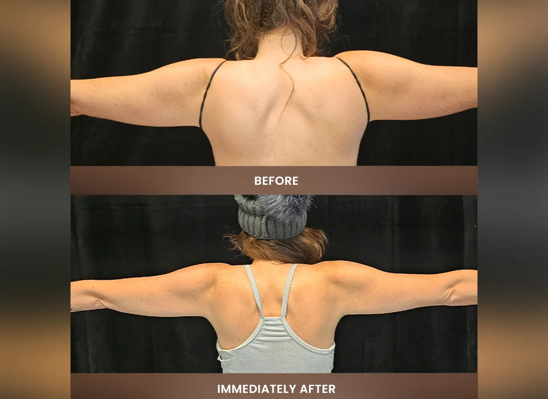 Laser Liposuction before and after result — Upper arms & back