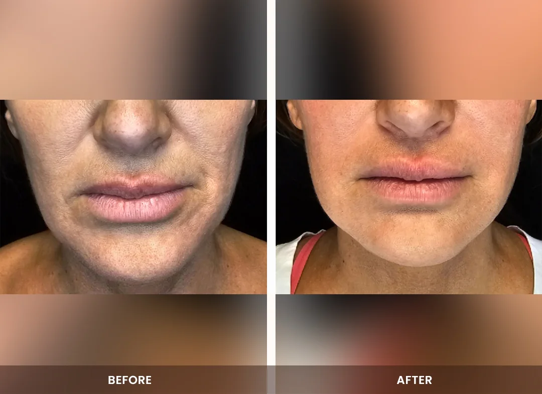Laser Liposuction before and after result — Face & jawline