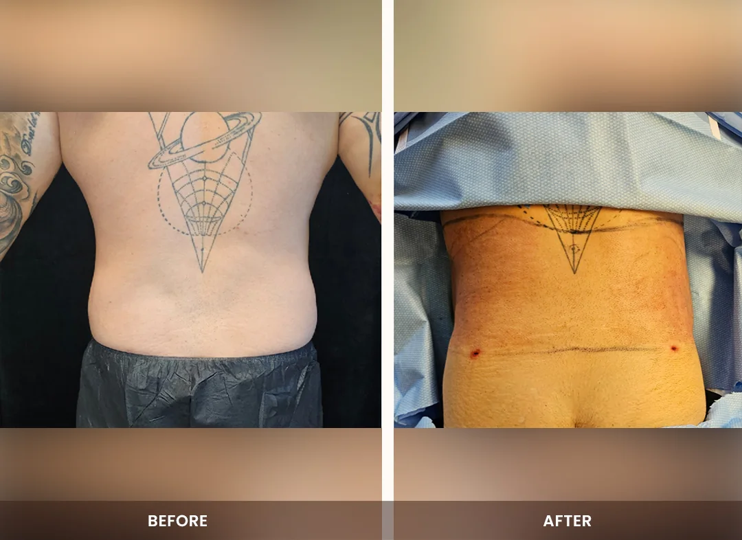 Laser Liposuction before and after result — Back & flanks