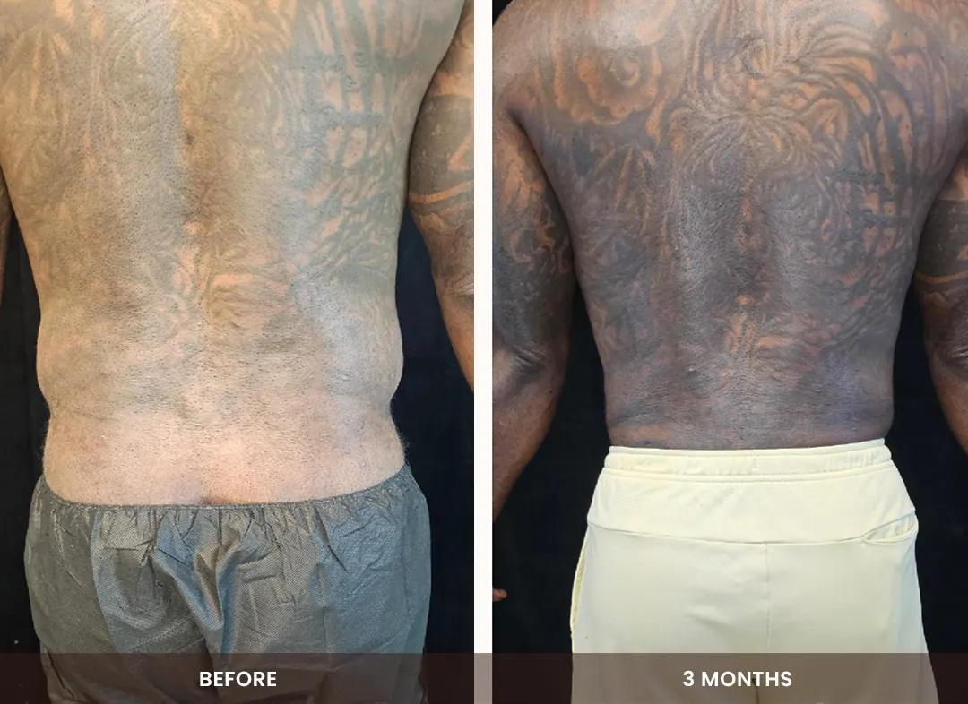 Laser Liposuction before and after result — Back & flanks