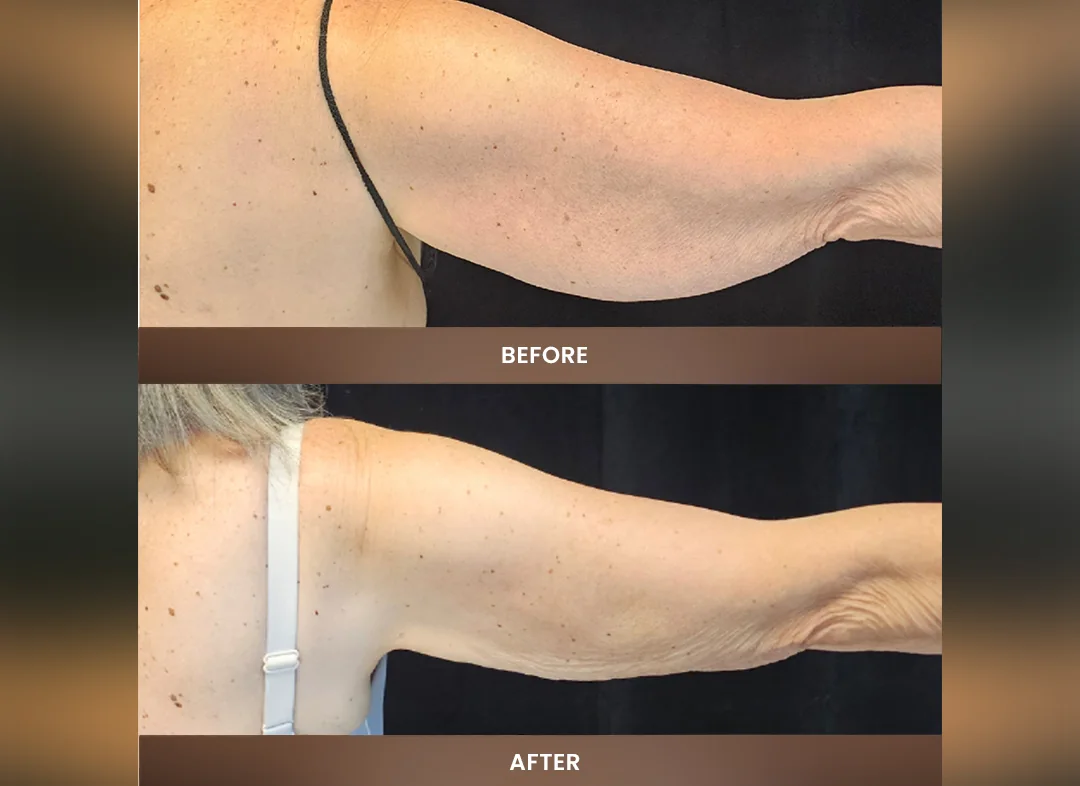 Laser Liposuction before and after result — Upper arm