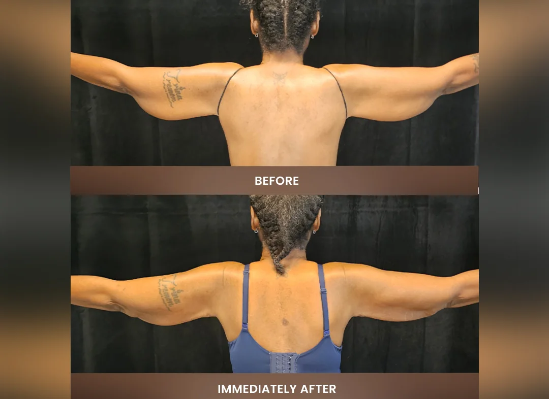 Laser Liposuction before and after result — Upper arms