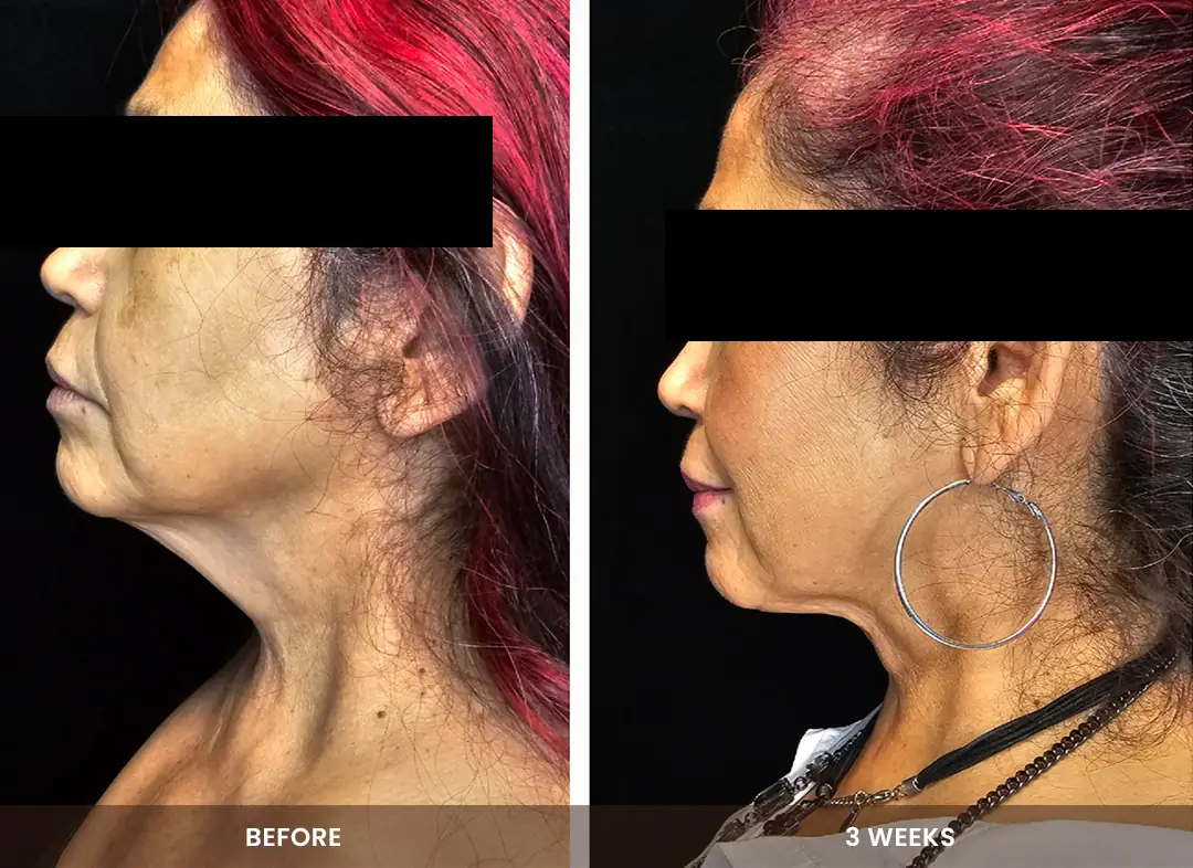 Laser Liposuction before and after result — Neck & jawline