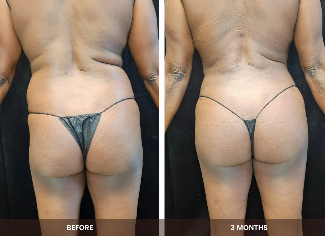 Laser Liposuction before and after result — Hips & buttocks