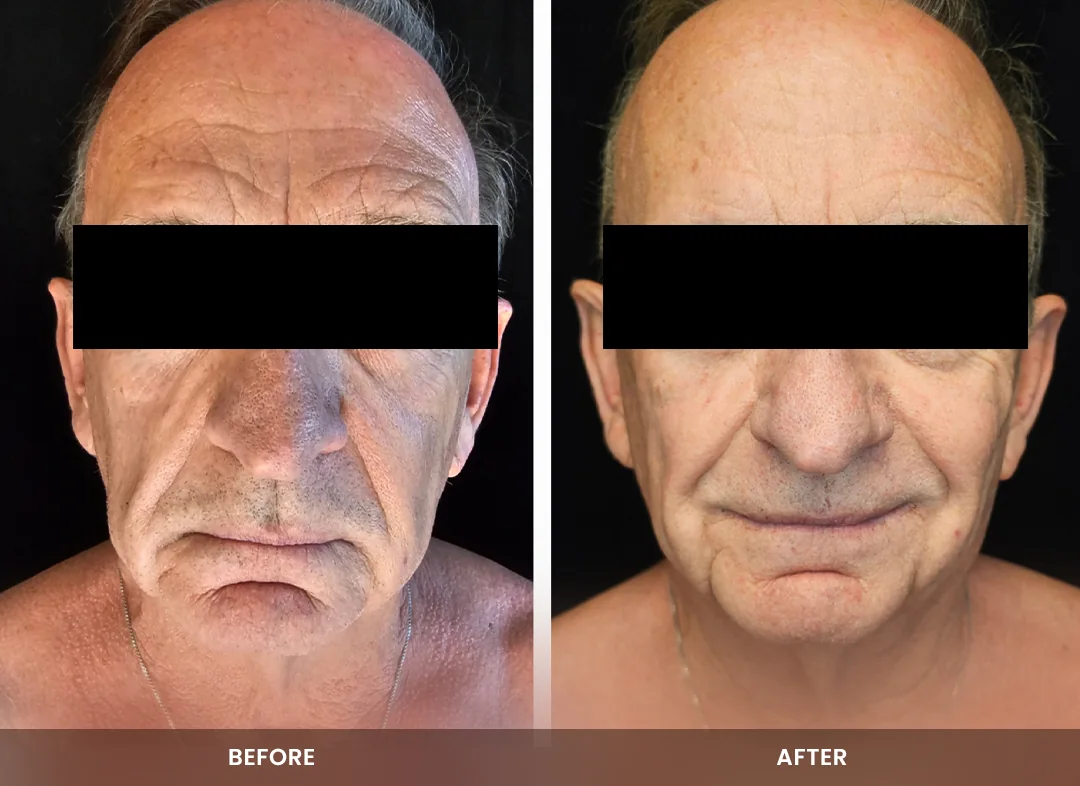 Skin Tightening before and after result — Face