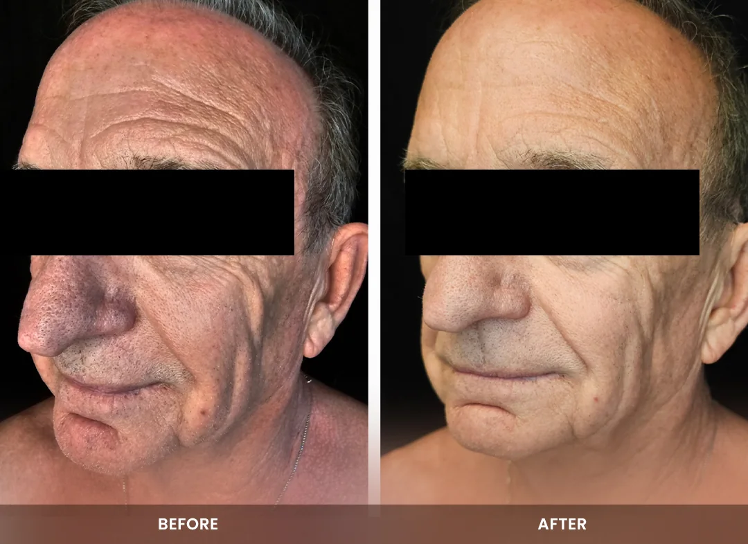 Skin Tightening before and after result — Face