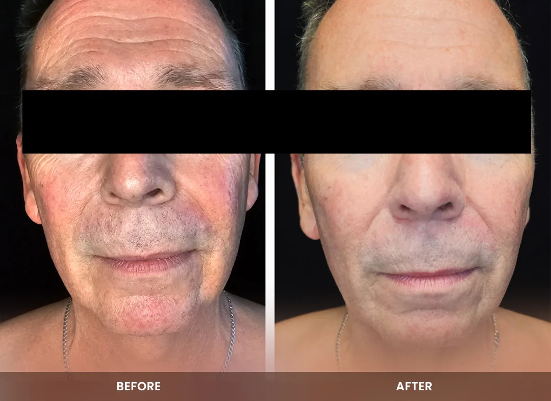 Skin Tightening before and after result — Face