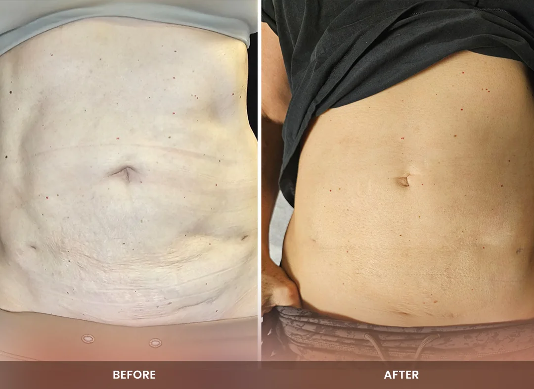 Skin Tightening before and after result — Abdomen