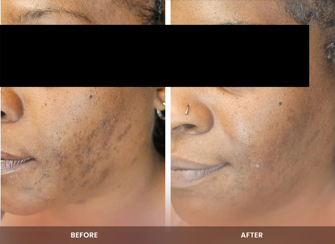 Skin Tightening before and after result — Face & eye area