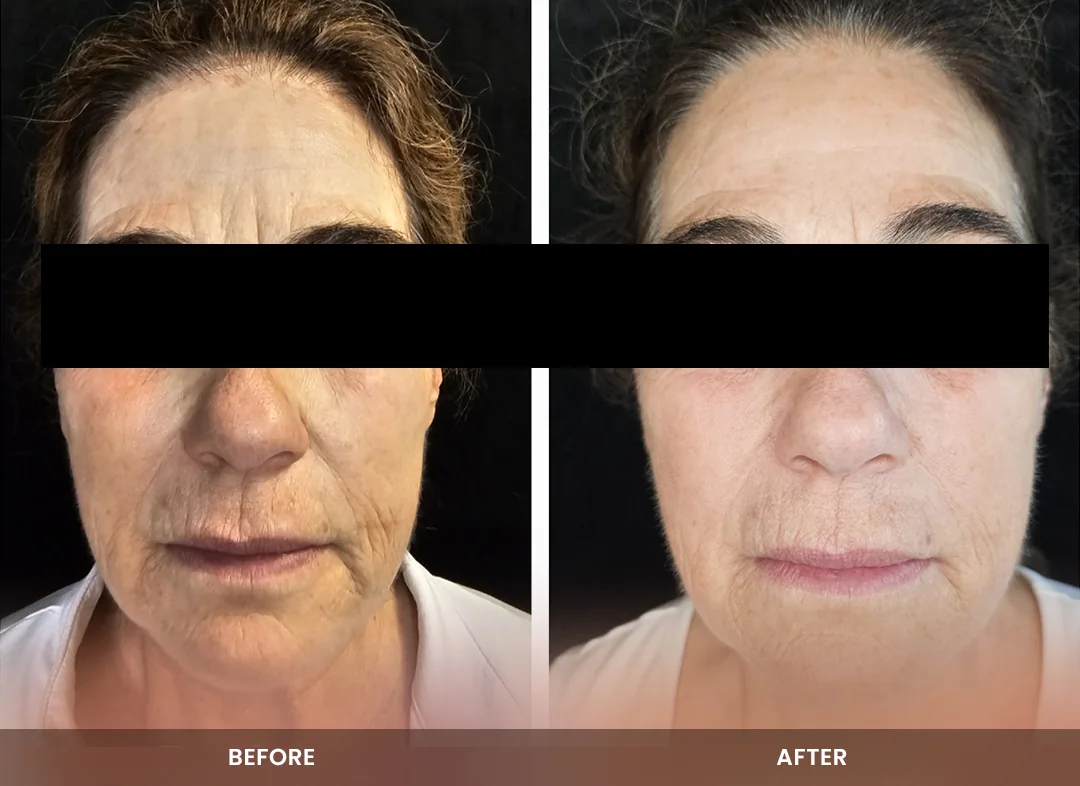 Skin Tightening before and after result — Face