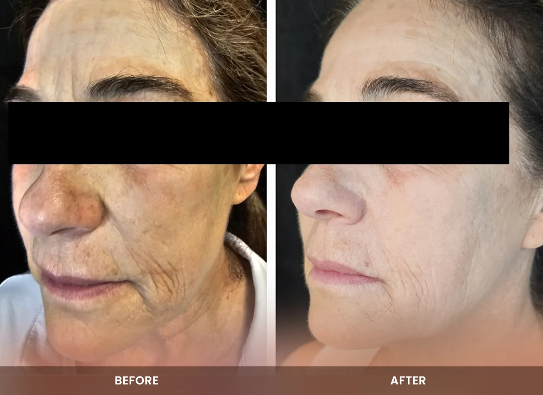 Skin Tightening before and after result — Face