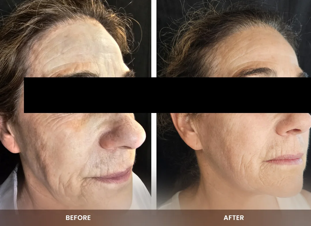 Skin Tightening before and after result — Face