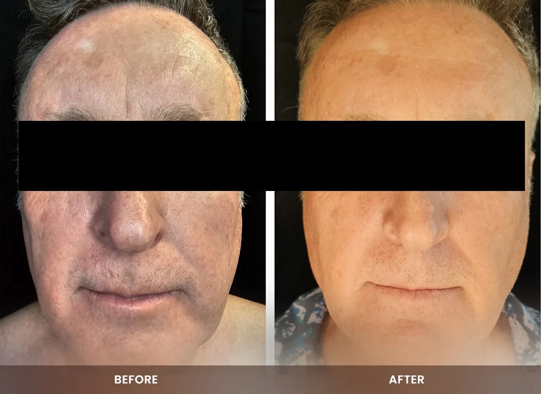 Skin Tightening before and after result — Face