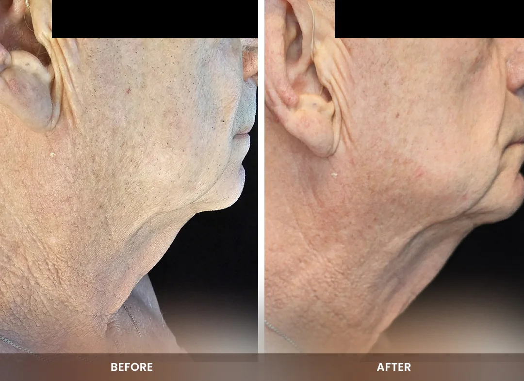 Skin Tightening before and after result — Neck & jawline