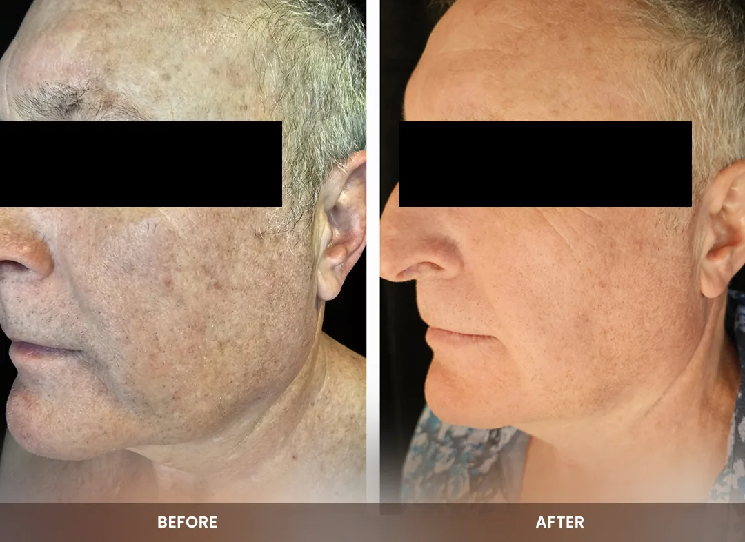 Skin Tightening before and after result — Face